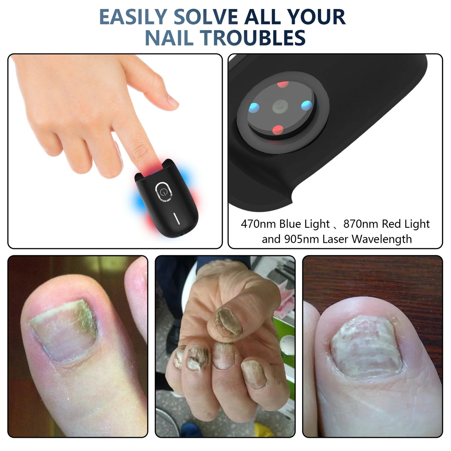 KTS Nail Fungus Laser Device Toenail Laser Therapy Machine - Supersell
