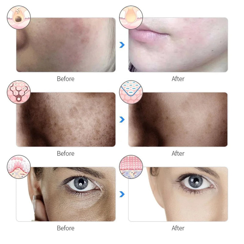 Skin Rejuvenation Facial Photon Light Therapy Device - Supersell